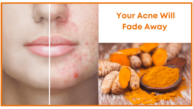 Turmeric Natural Health Benefits - Your acne will fade away